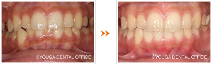 下顎前歯の部分矯正：閉じた状態