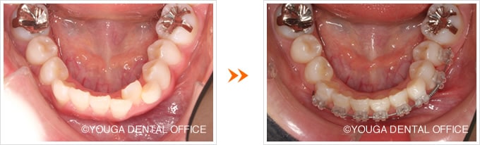 下顎前歯の部分矯正：治療中