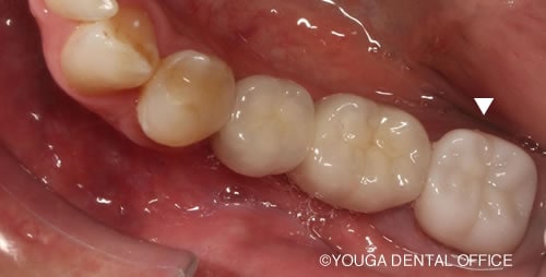 奥歯の病巣と違和感