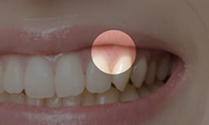 歯ぐきの移植・整形・再生