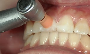 PMTC 歯のクリーニング 歯石 着色汚れ