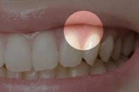 前歯の歯ぐき