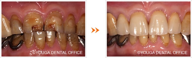 前歯のオールセラミッククラウン症例