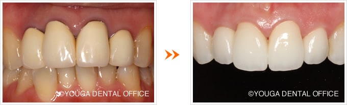 変色した歯ぐき・前歯4本のオールセラミック術前術後