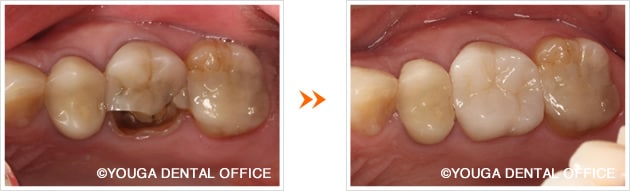 奥歯のオールセラミッククラウン症例