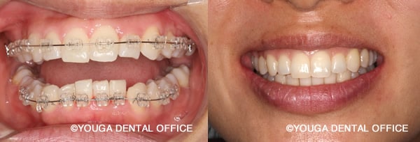 装置と前歯の歯並び