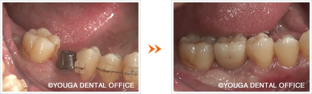 奥歯6番のインプラント症例