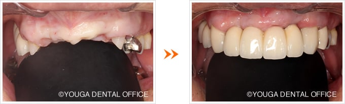 前歯の術前術後
