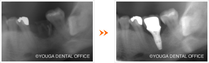 奥歯のインプラントX線