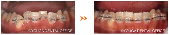下顎前歯の部分矯正：術中