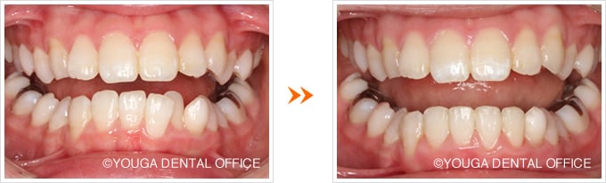 下顎前歯の部分矯正：正面術前術後