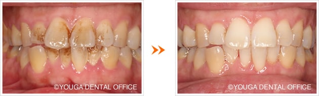 予防歯科 PMTC 歯のクリーニングや歯石の除去 | 世田谷区・用賀デンタルオフィス