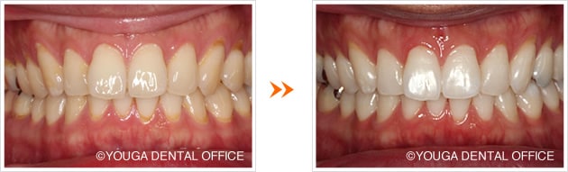 前歯のホワイトニング症例