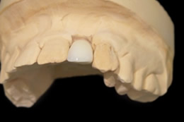 インプラントの歯