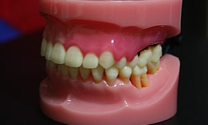 歯周病・歯槽膿漏